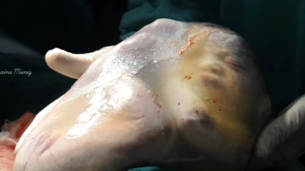 Mãe dá à luz gêmeas e uma das bebês nasce empelicada em Balneário Camboriú