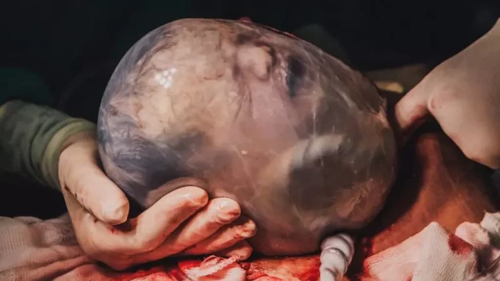 Parto raro é registrado em BC e imagens impressionam