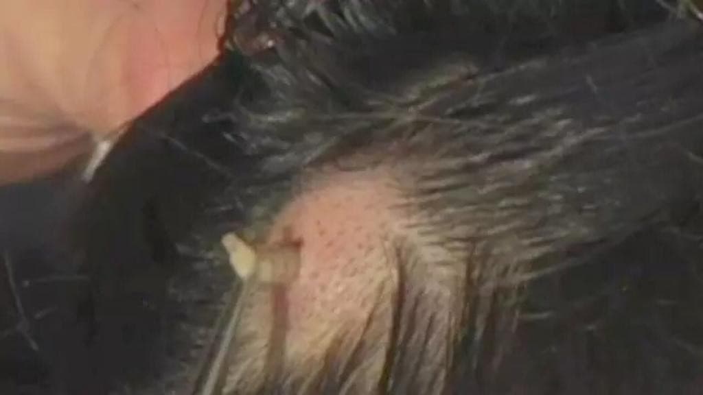 Menina de 4 anos é resgatada com larvas na cabeça: “se alimentando da carne”