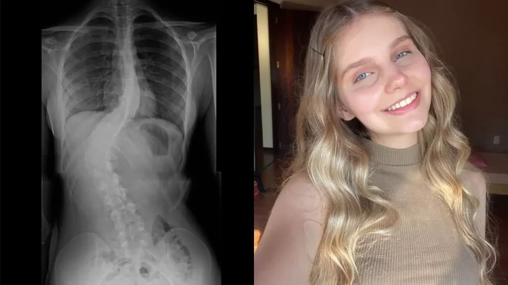 Jovem necessita de ajuda para realização imediata de cirurgia de coluna