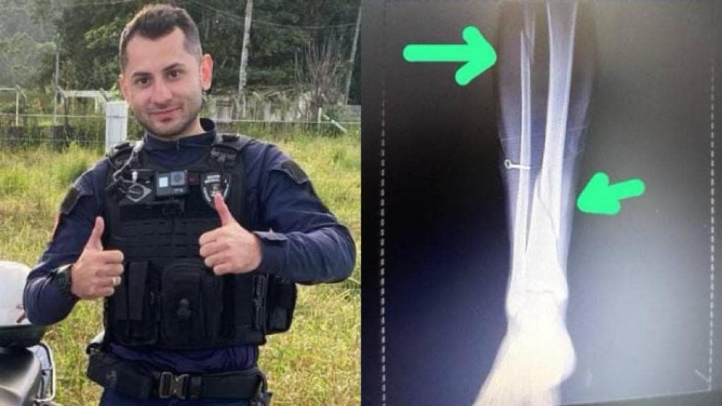 GM de Itapema tem perna quebrada por homem furioso em ocorrência e precisa de ajuda