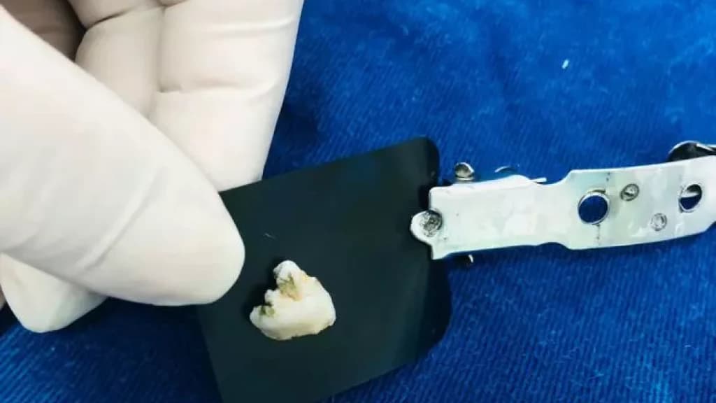 Dente “não humano” é encontrado em marmita de funcionária em Centro de Saúde
