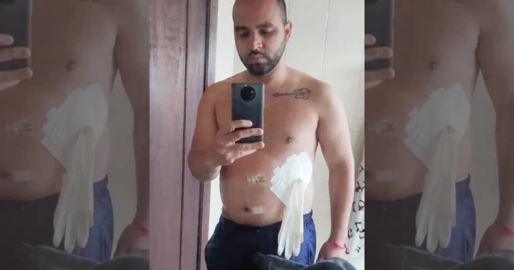 Médico coloca luva cirúrgica no lugar de bolsa de colostomia em paciente