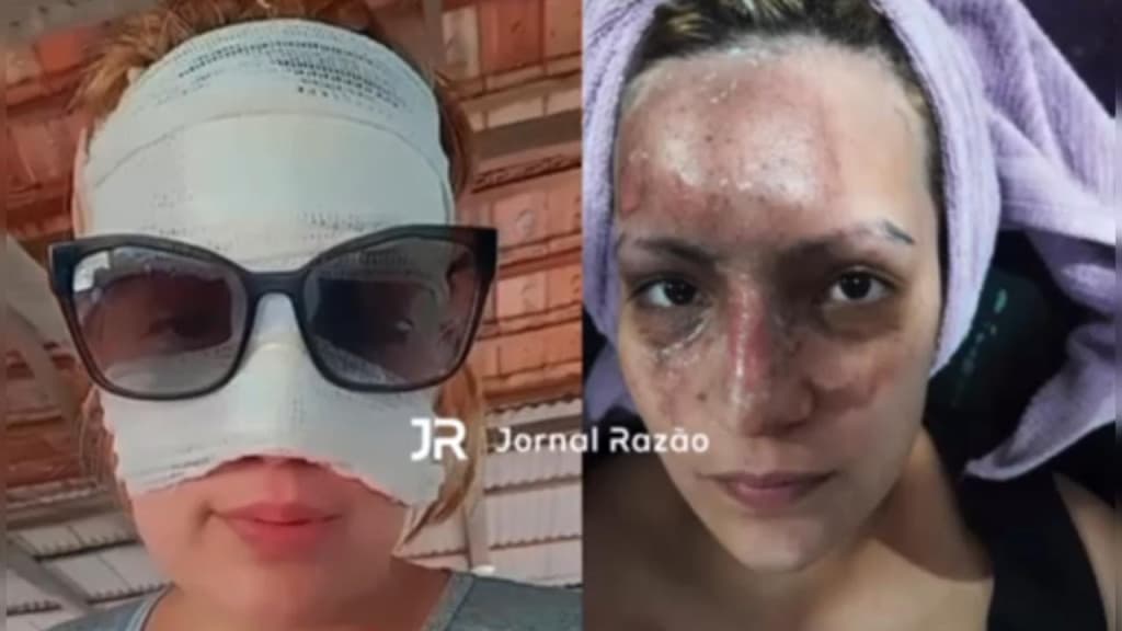 Leite quente “explode” no micro-ondas e moradora de SC tem 70% do rosto queimado