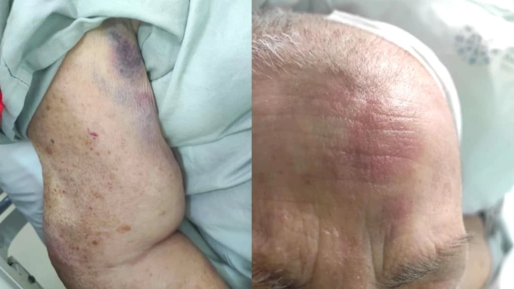 Enfermeiro espanca idosa de Canelinha, de 73 anos, na UTI de hospital