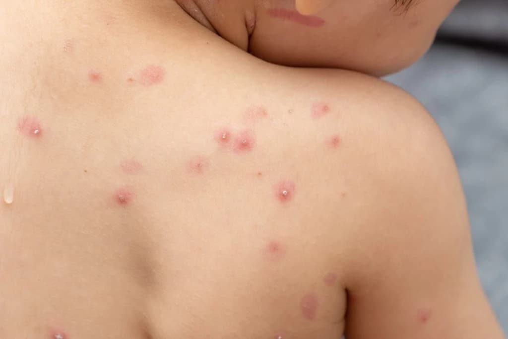 Varíola dos macacos: Anvisa libera uso de antiviral e vacina no Brasil