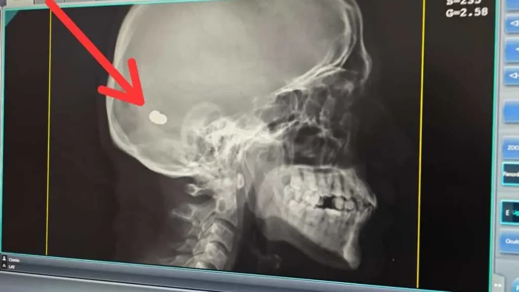 Homem descobre bala na cabeça após procurar ajuda médica