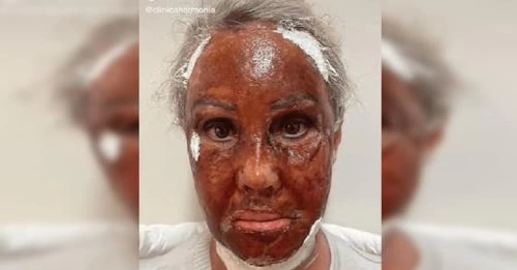 VÍDEO: mulher tem rosto queimado durante procedimento estético em SC