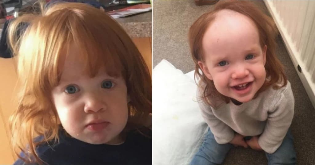 Menina confunde creme depilatório com gel de cabelo e ganha penteado de “calvície”