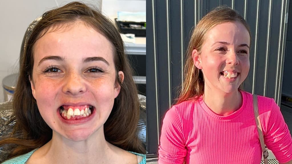 Menina de Tijucas que tinha “trauma do sorriso” ganha transformação