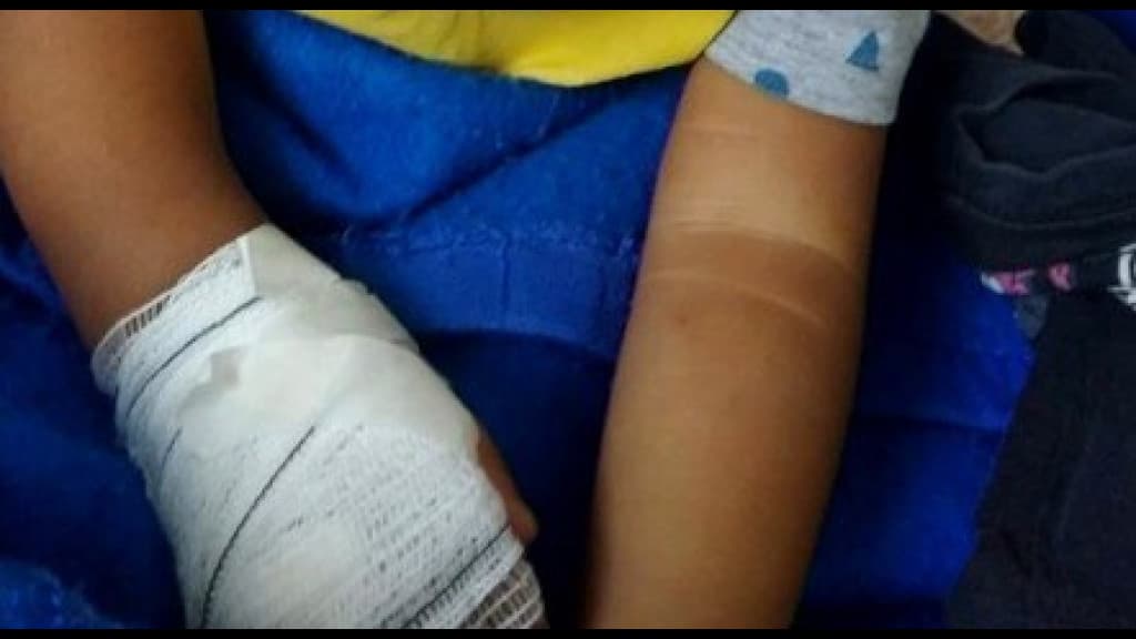 Bebê internada por inflamação na testa tem dedo amputado após corte na hora de tirar atadura