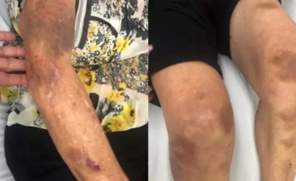 Idosa com hematomas graves acusa marido de estupro com desodorante em Itajaí