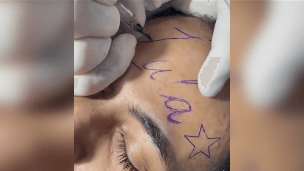 Jovem realiza sonho e tatua Lula na testa: “apaixonado pelo petista”