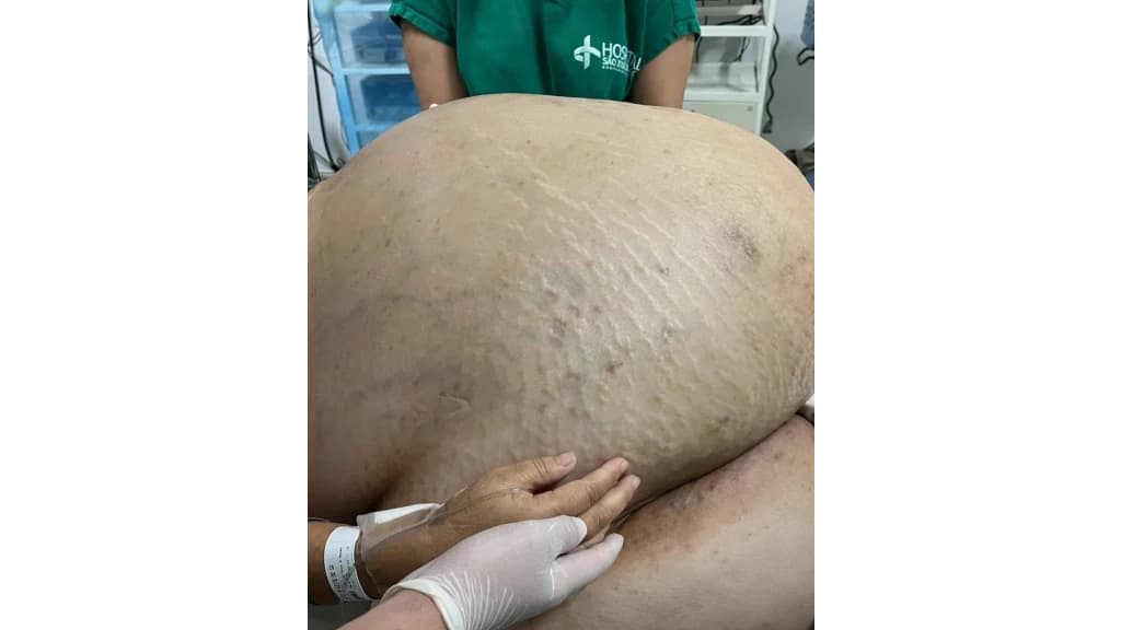 Tumor com cerca de 46 kg é retirado de mulher em cirurgia de emergência