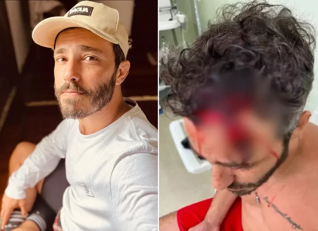 “Está em choque”, diz empresária de ator que teve couro cabeludo arrancado
