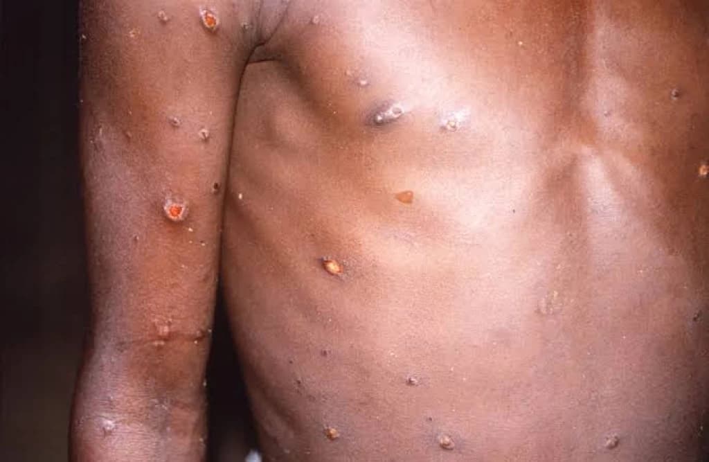 Suspeitos de contaminação por varíola dos macacos devem fazer sexo vestidos