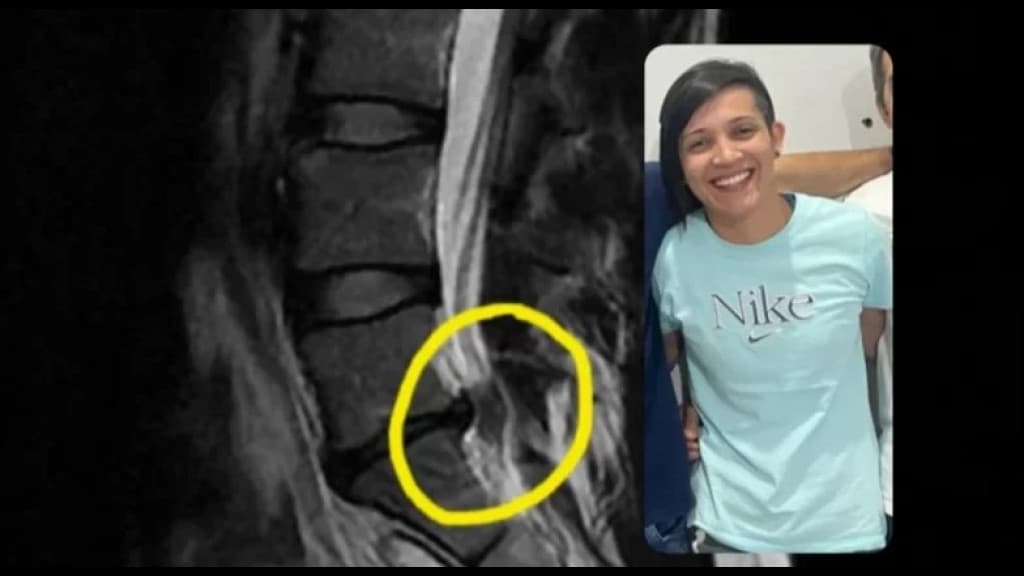 Professora de Itapema precisa de ajuda para cirurgia na coluna