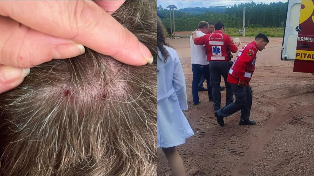 Homem leva mordida de cobra na cabeça em SC