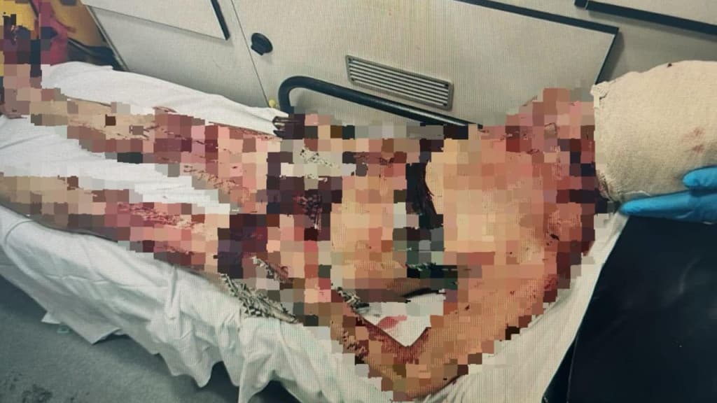 “Caiu sozinha”, diz homem após enfiar garfo no rosto da esposa em Itapema