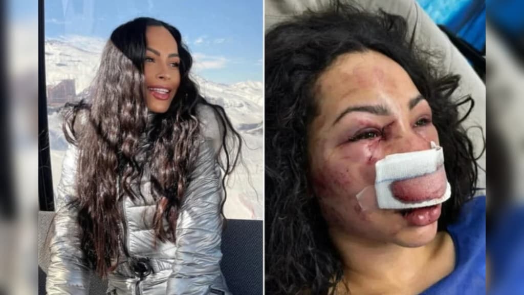 Paranaense é brutalmente espancada durante assalto e tentativa de estupro no Chile