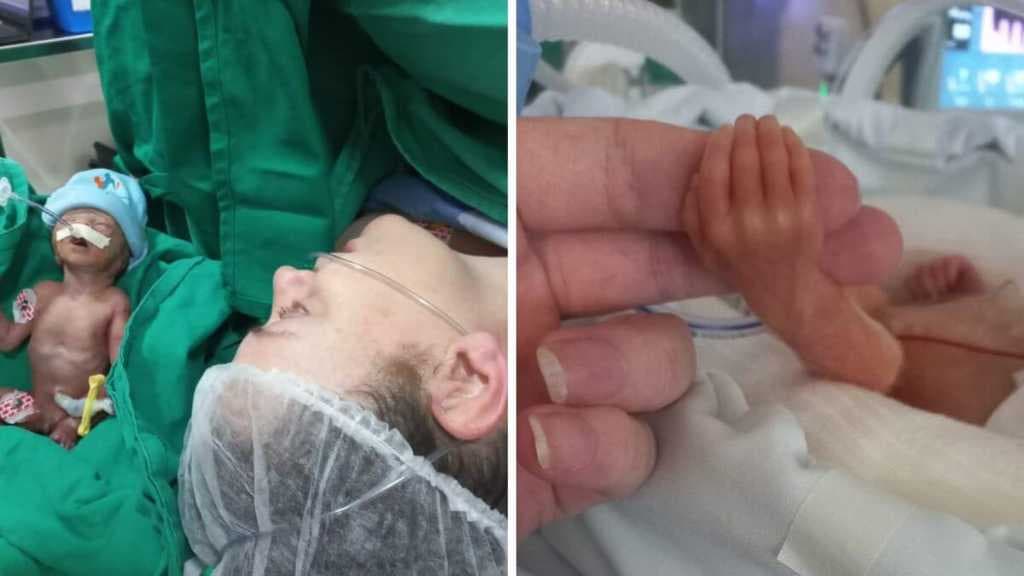 O milagre e a vitória de um bebê de apenas 800 gramas que lutou para viver
