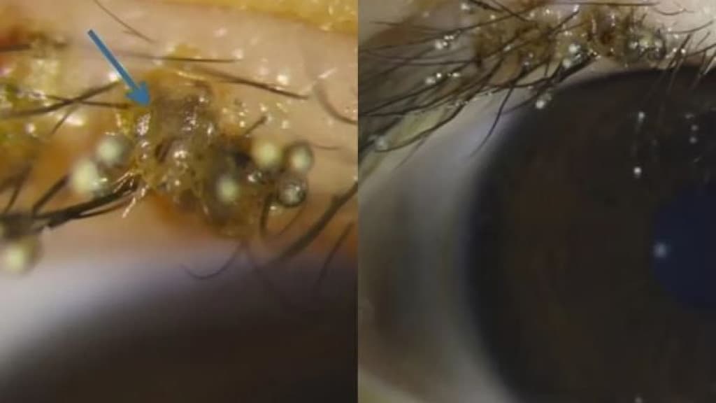 Brincadeira na areia resulta em infestação de piolhos nos cílios de criança