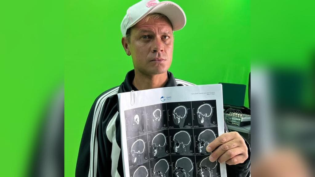 Morador de Tijucas é espancado em assalto, tem maxilar quebrado e luta por cirurgia