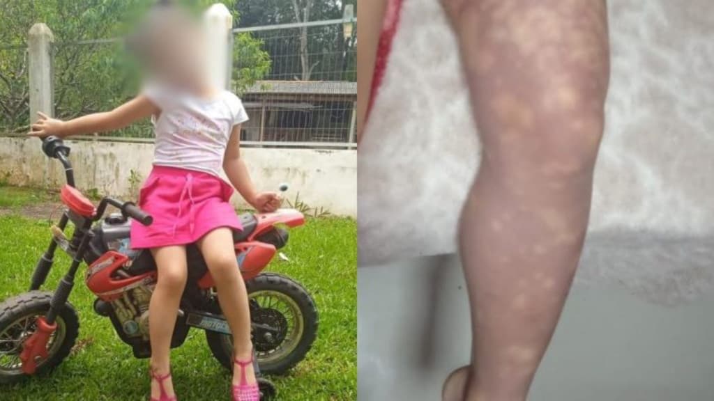 “Quero uma perninha”: criança desabafa após tragédia causada por injeção em SC