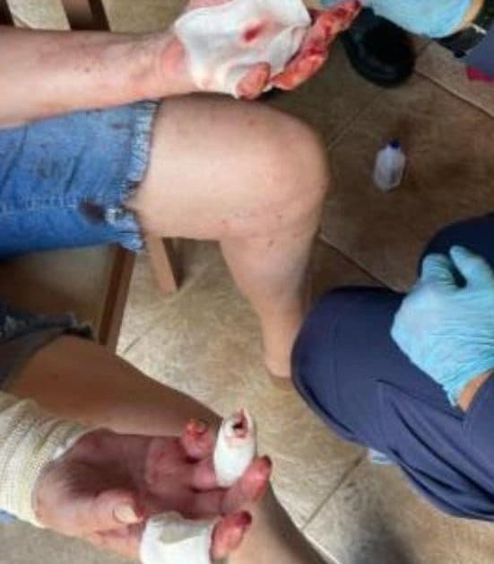 Mulher tenta salvar cachorro de ataque de pitbull e acaba ferida em Rio do Sul