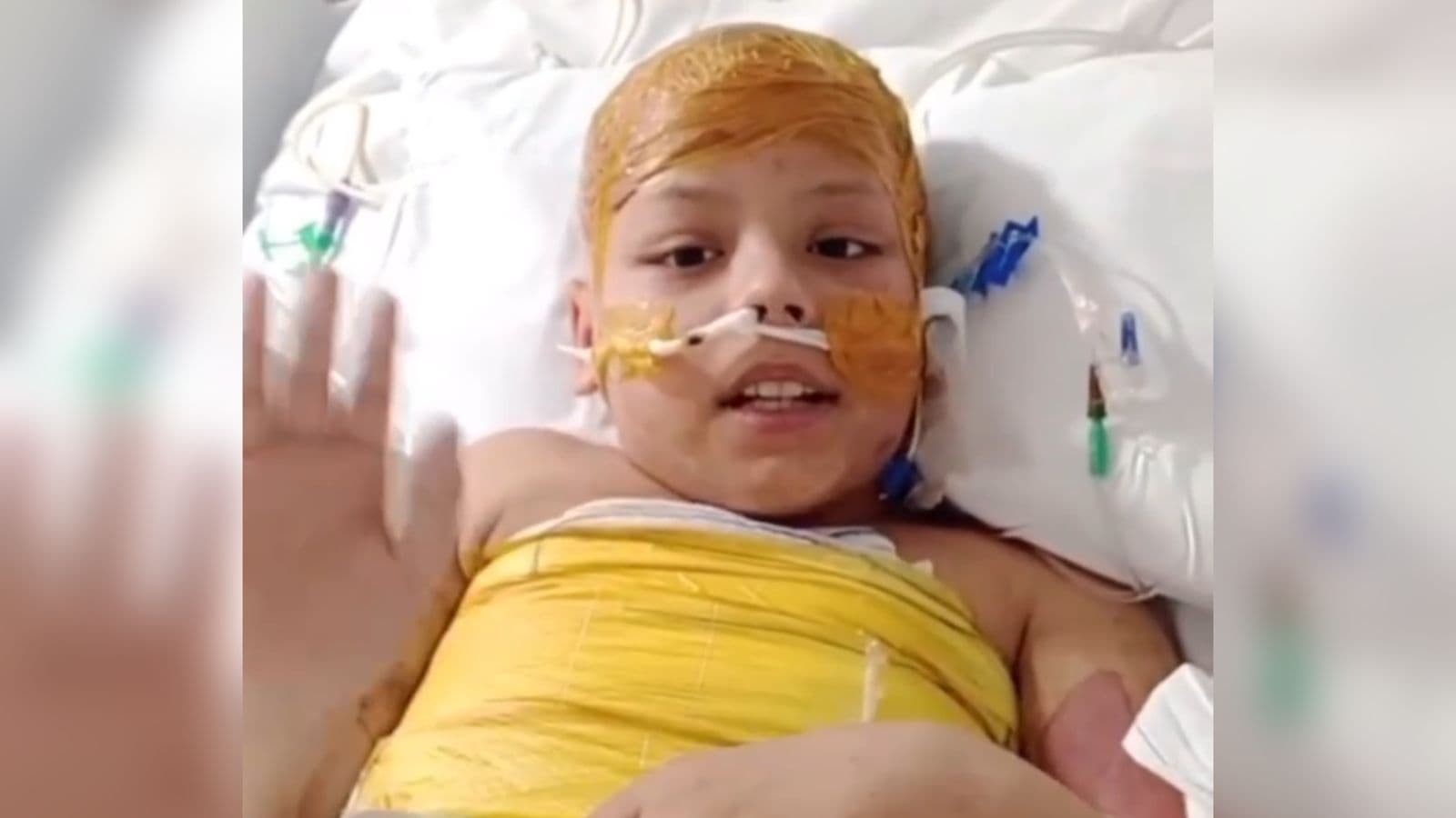“Milagre”: criança sobrevive a descarga de 25 mil volts e emociona com vídeo gravado em hospital de SC