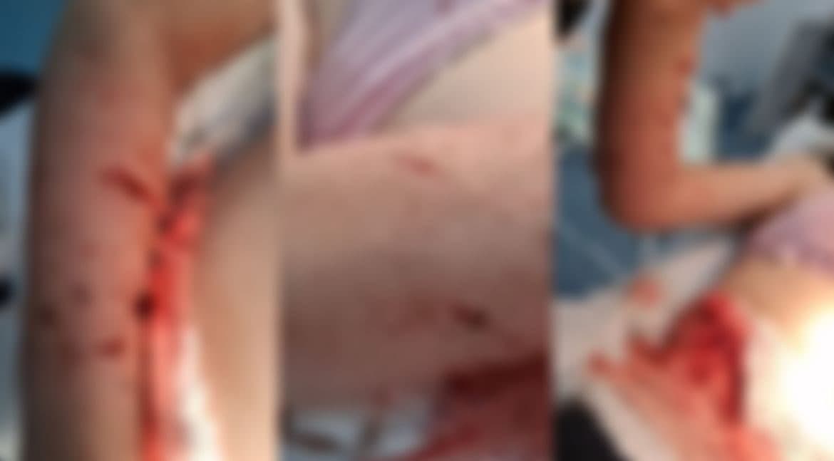 “Não é agressivo”, garante tutora de pit bull após criança ser atacada e levar 62 pontos em SC