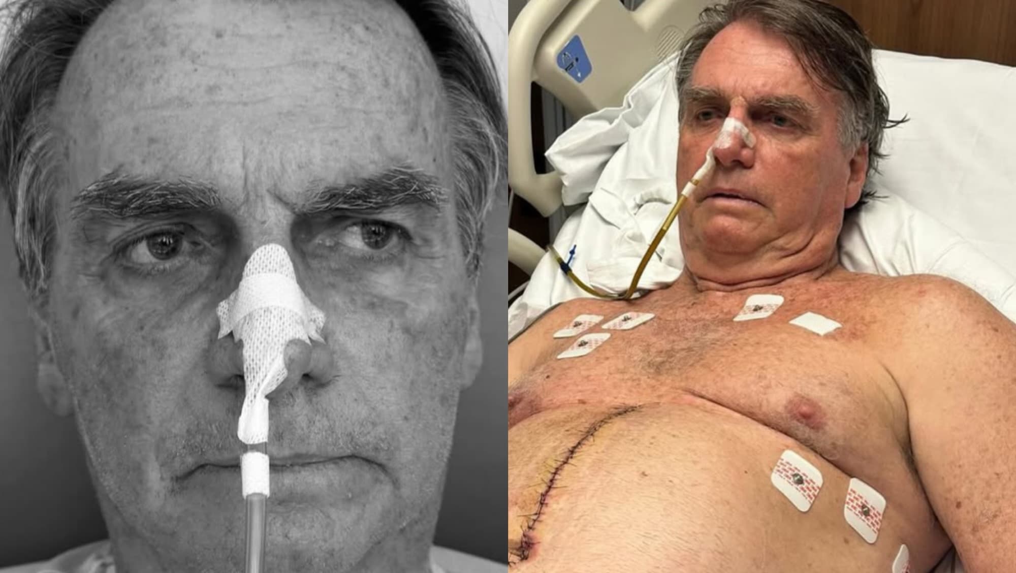 “Câncer de pele em estágio inicial”, apontam exames no ex-presidente Bolsonaro