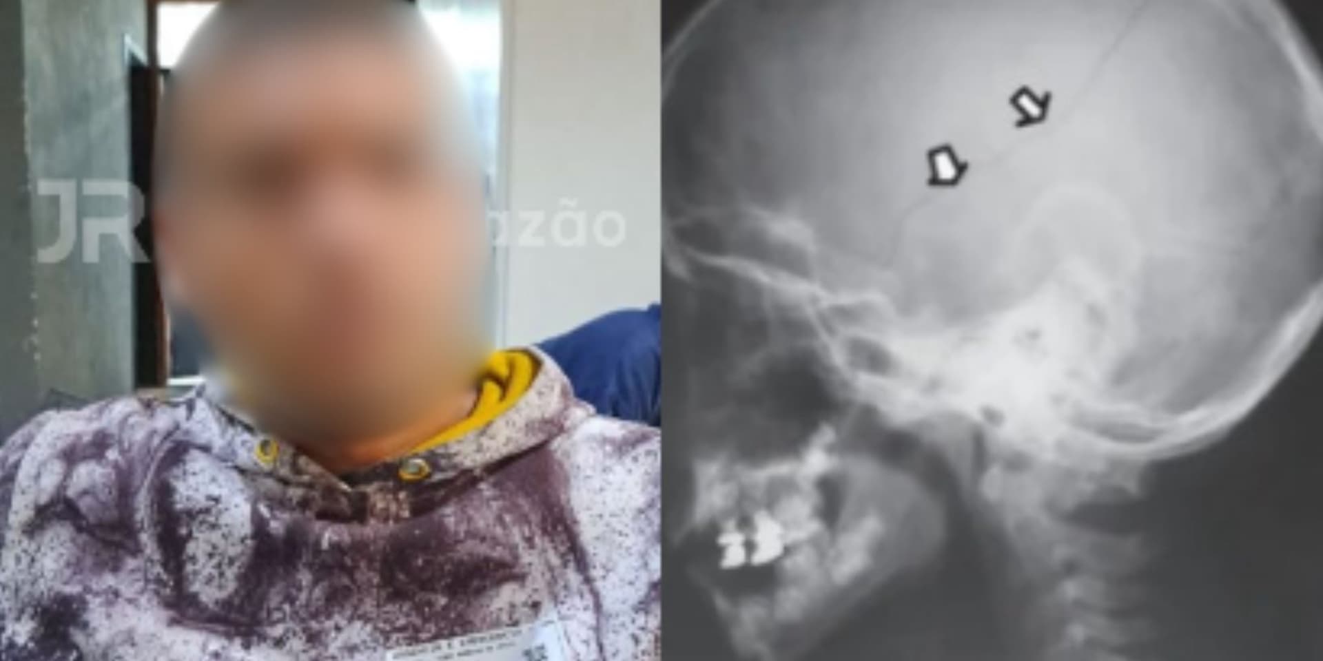 “Trauma cerebral”: padrasto é preso após menina de 4 anos ser internada na UTI em Blumenau