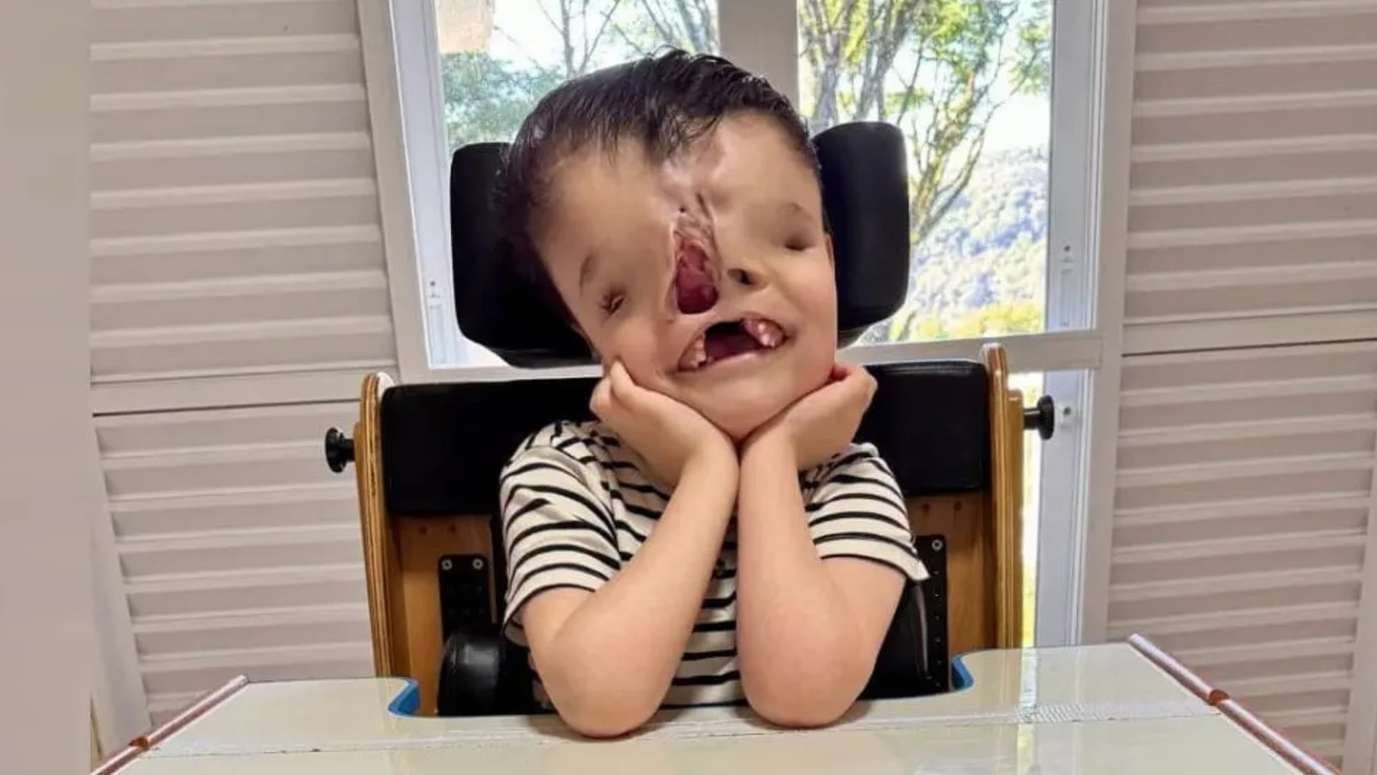 “Cada dia é mais dor”: menino de 7 anos precisa de cirurgia urgente em SC