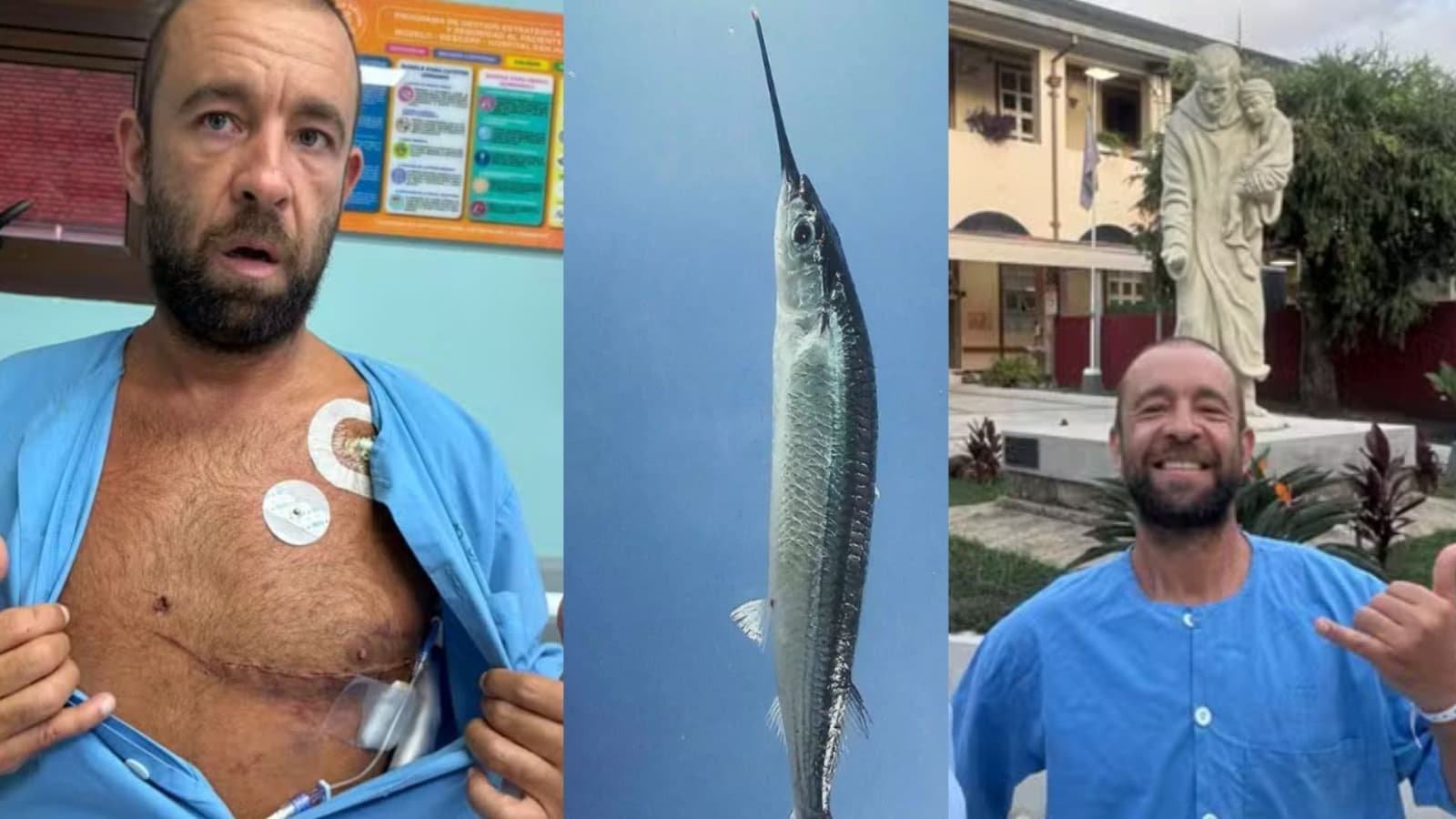 “Achei que não voltaria”: surfista catarinense atingido no coração por peixe-agulha recebe alta