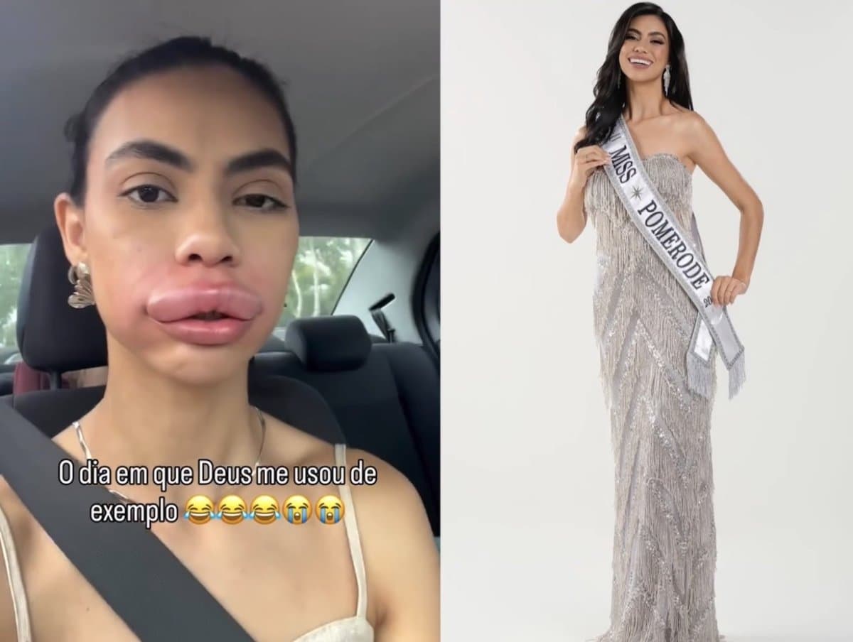 “É normal assim?”: Miss Pomerode viraliza com inchaço nos lábios após procedimento estético em SC