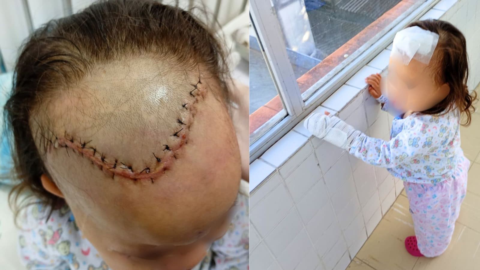 Criança de Itapema enfrenta tumor raro no cérebro e família faz apelo por ajuda no tratamento