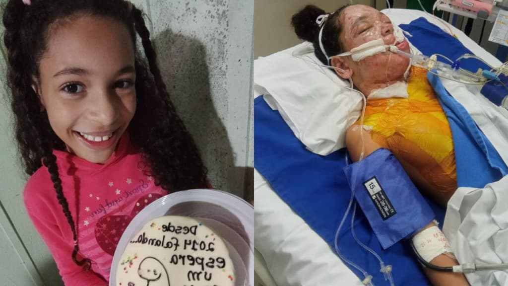 “Milagre”: acidente doméstico quase mata menina de 10 anos