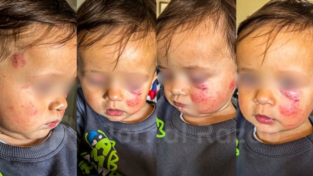 Menino é atacado por bebê em creche: “não foi apenas uma mordida”