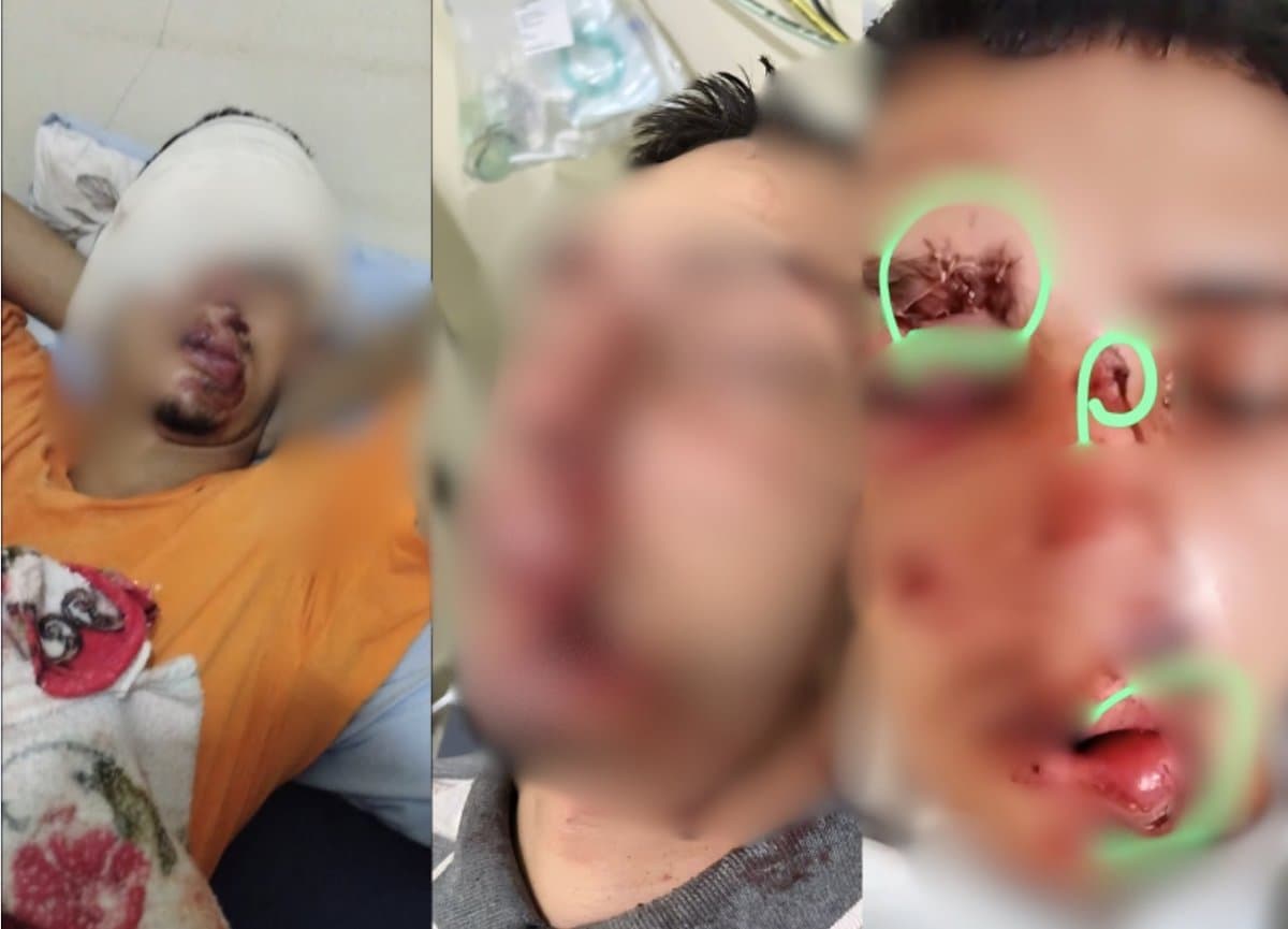 Morador de Tijucas tem rosto desfigurado em ataque de cães: “arrancaram pedaços”
