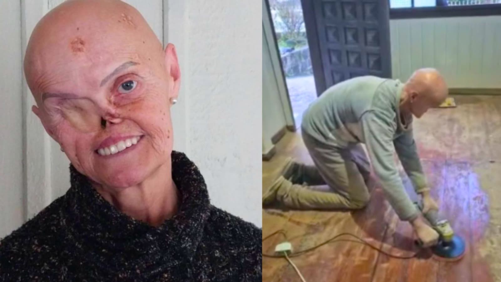 “Me chamam de ET”: o chocante relato da moradora de Itaiópolis que enfrentou 73 cânceres e a crueldade da internet