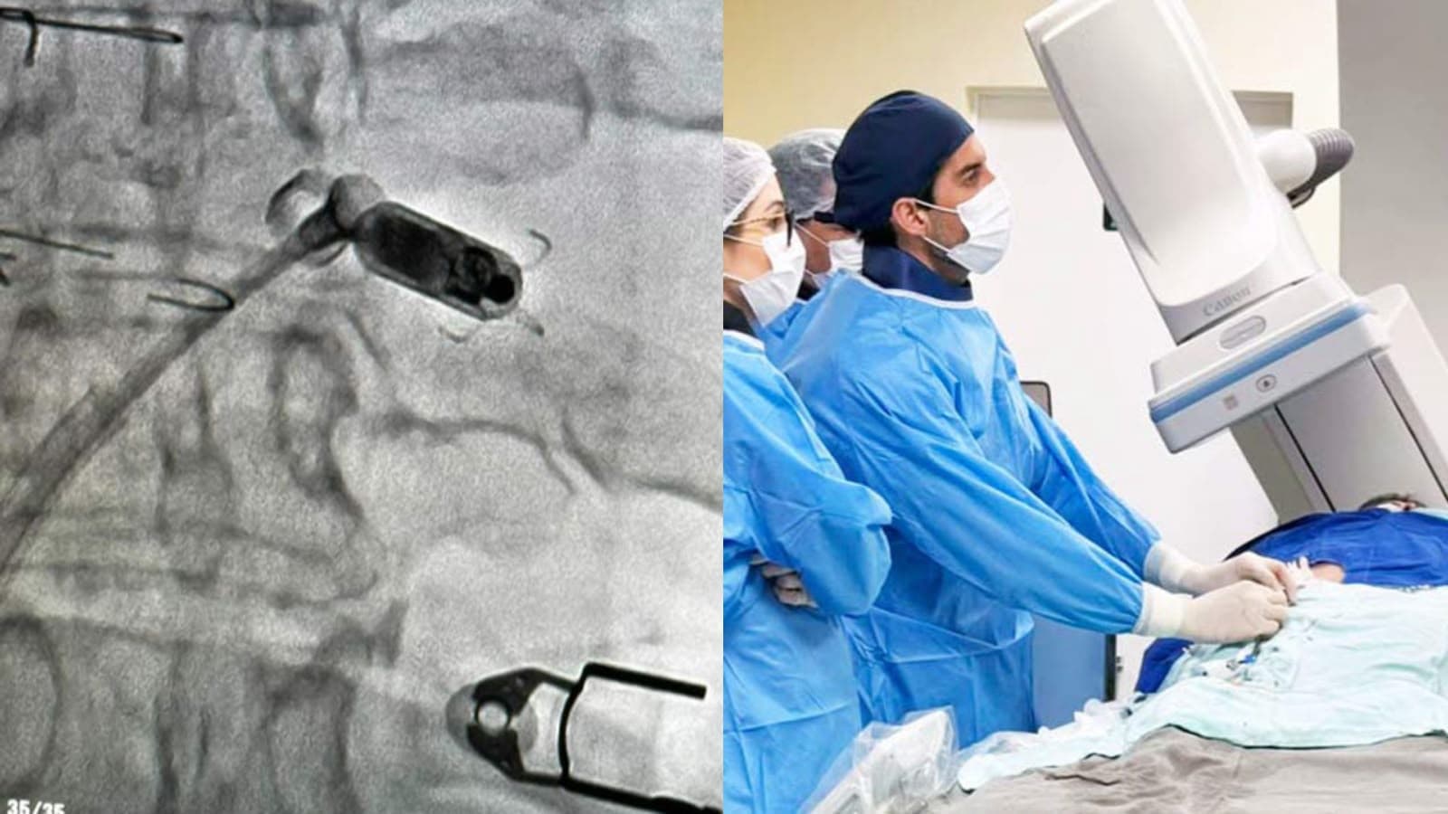 “25 vezes menor”: Blumenau recebe o marcapasso sem fio que dispensa eletrodos e faz história na cardiologia