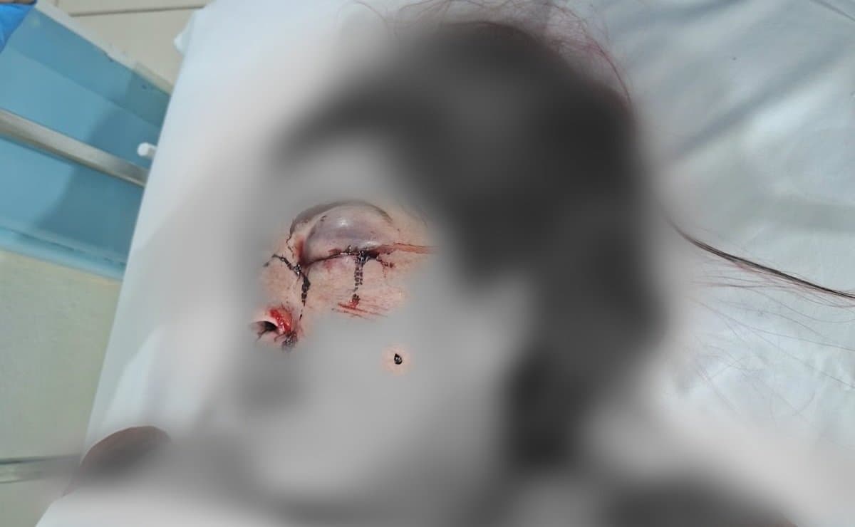"Não foi acidente": mulher ferida em batida de carro em Tijucas diz que levou um soco no olho do companheiro