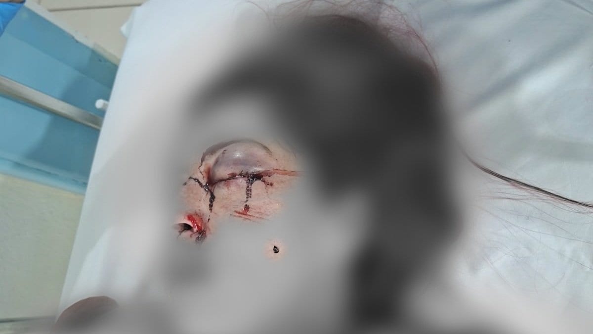 “Não foi acidente”: mulher ferida em batida de carro em Tijucas diz que levou um soco no olho do companheiro