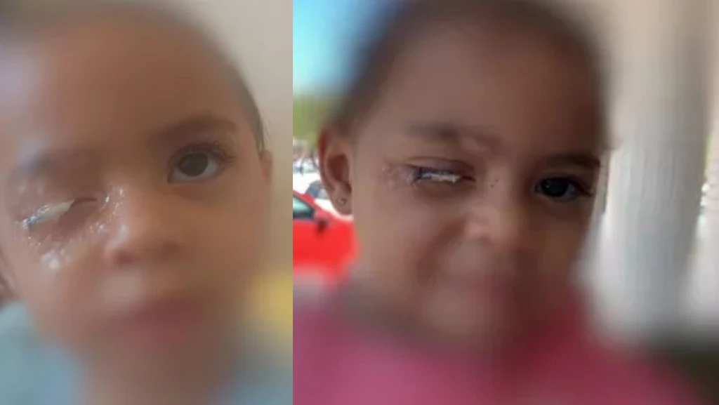 Menina de 2 anos cola o olho com super cola e vai parar no hospital