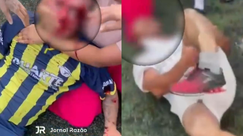 Pai é espancado e tem perna quebrada ao defender filho de agressão em partida de futebol