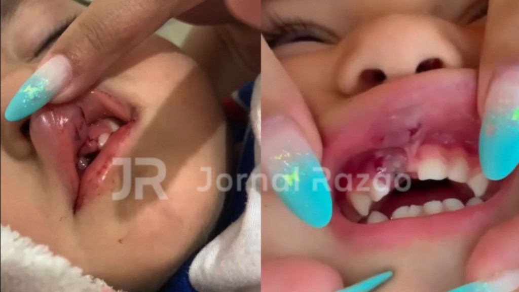 Menina de 3 anos tem dente arrancado pela raiz em creche