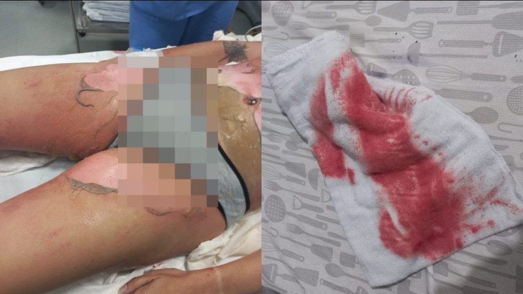 Briga de casal em Itapema termina com mulher no hospital: "50% do corpo queimado"