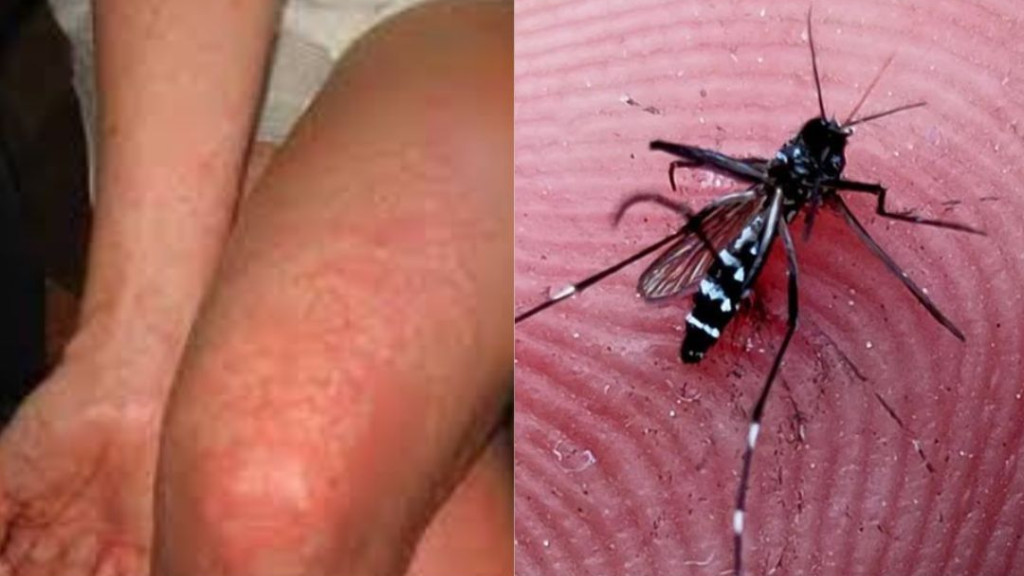 Após surto de dengue, Joinville confirma três casos de Chikungunya