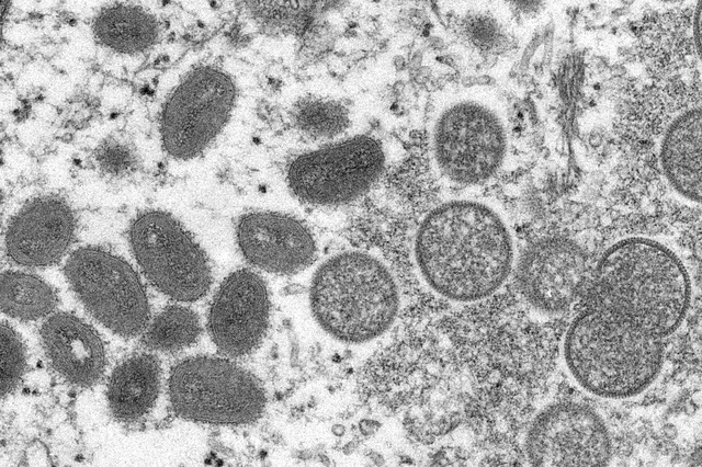 Segundo caso suspeito de varíola de macaco é registrado em SC